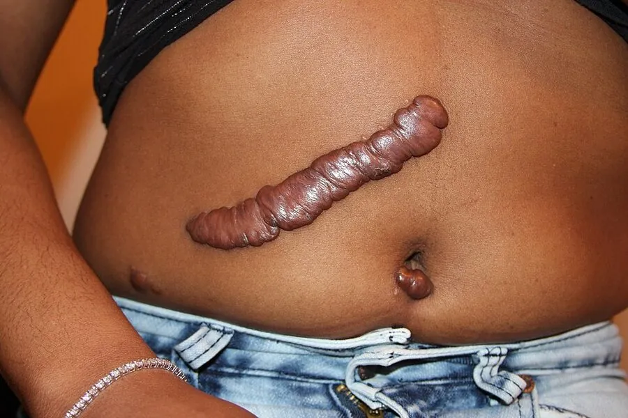 A keloid overgrowing the boundaries of the original surgical wound