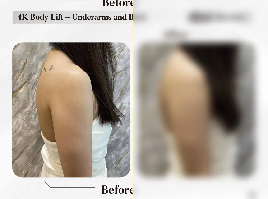 4K Body Lift — Underarms & Back (Single Session)