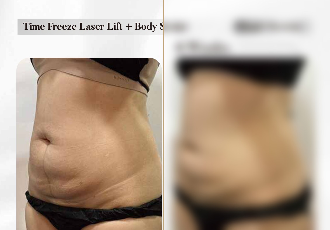 Time Freeze Laser Lift + Body Sculpt — 6 Weeks (Single Session)