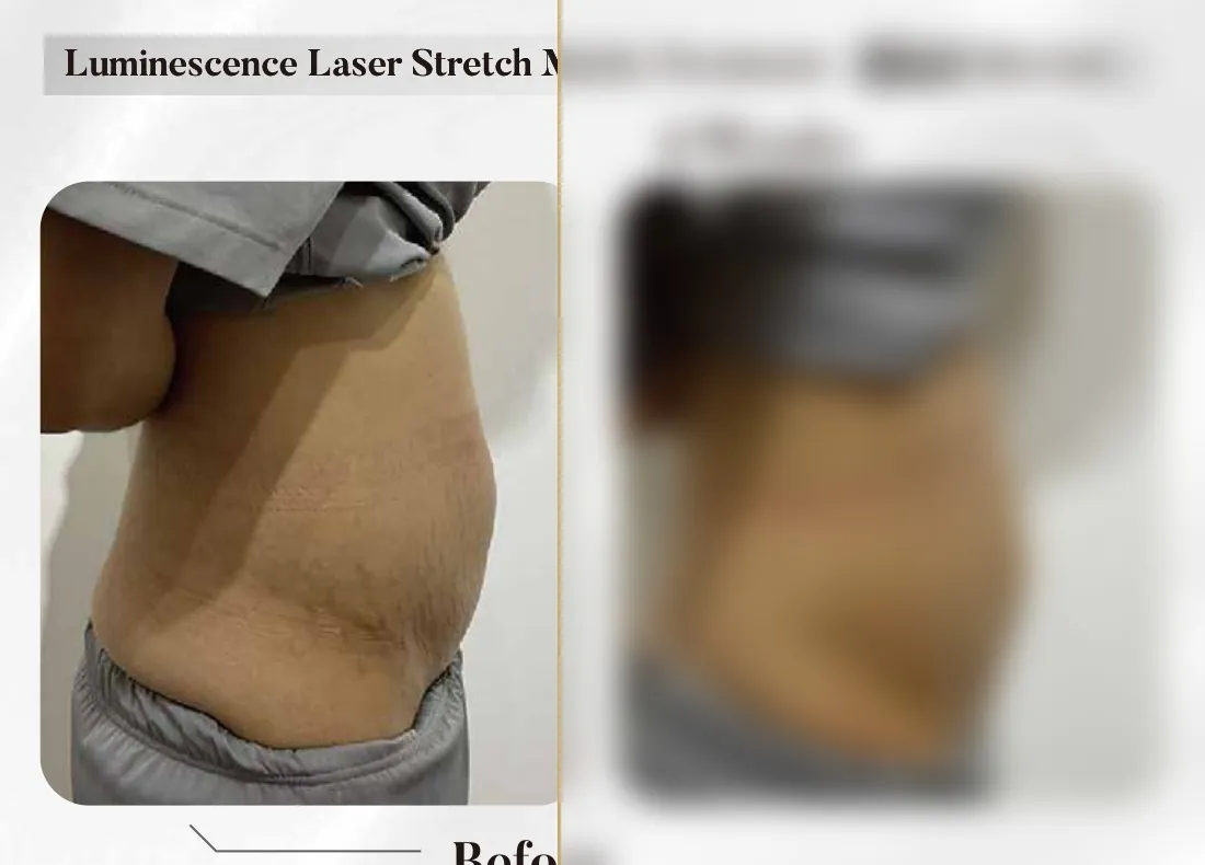 Luminescence Laser — Stretch Marks Treatment, 4 Weeks (Single Session)