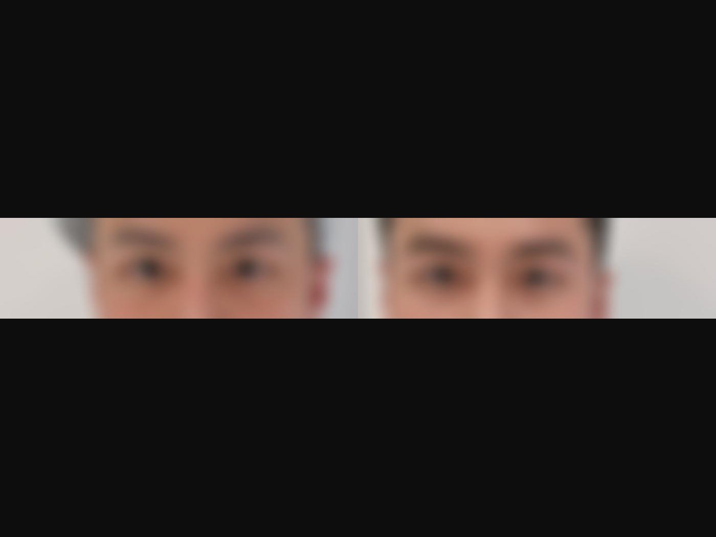 VF Periorbital Eyelift - Targets Hollowed Undereyes