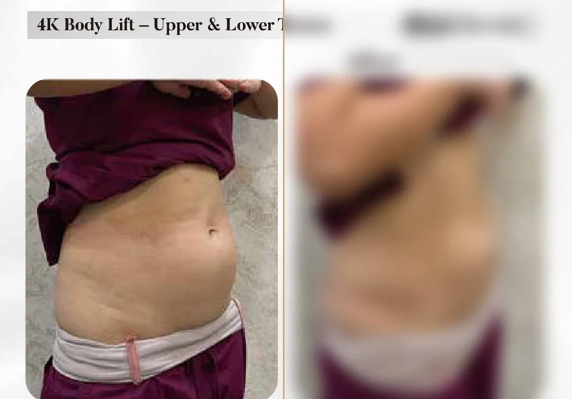 4K Body Lift — Upper & Lower Tummy Side Profile (Single Session)