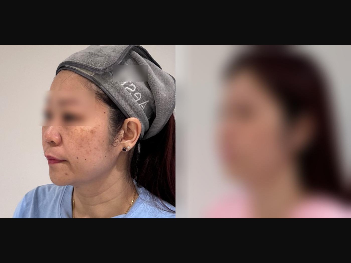 VF Lift - Lifts Jowls & Nasolabial Folds