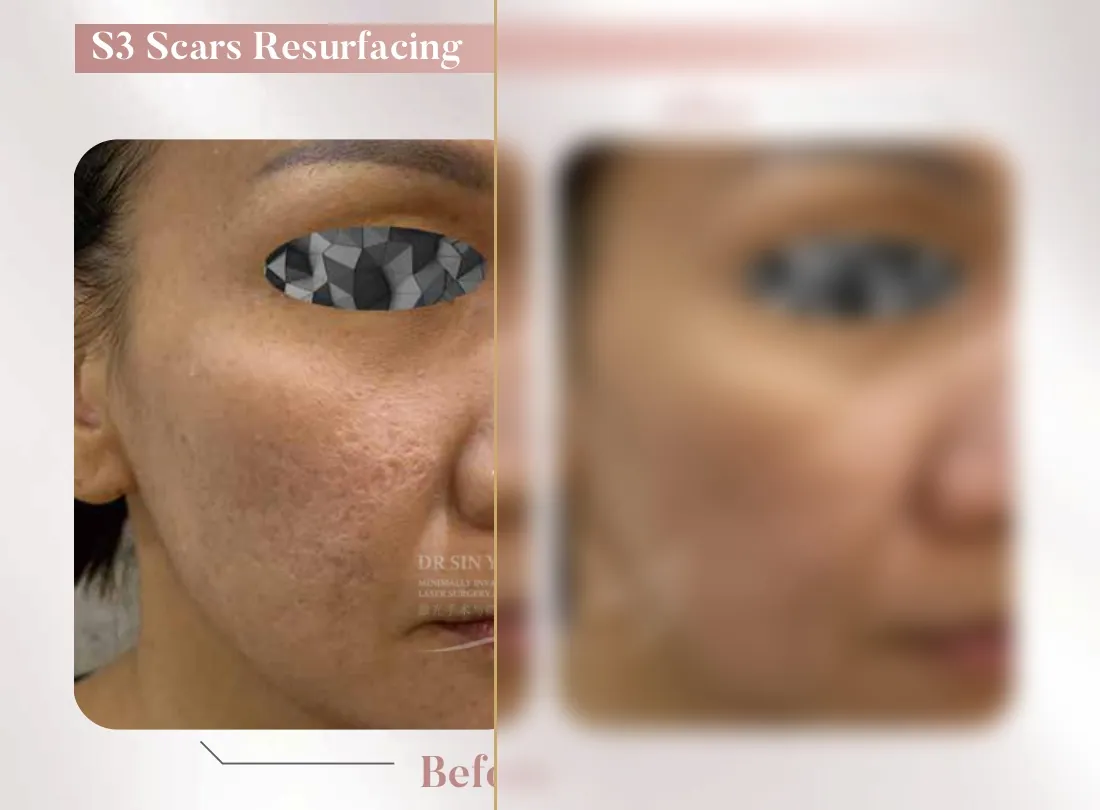 S3 Resurfacing Lift Laser — Scars Resurfacing