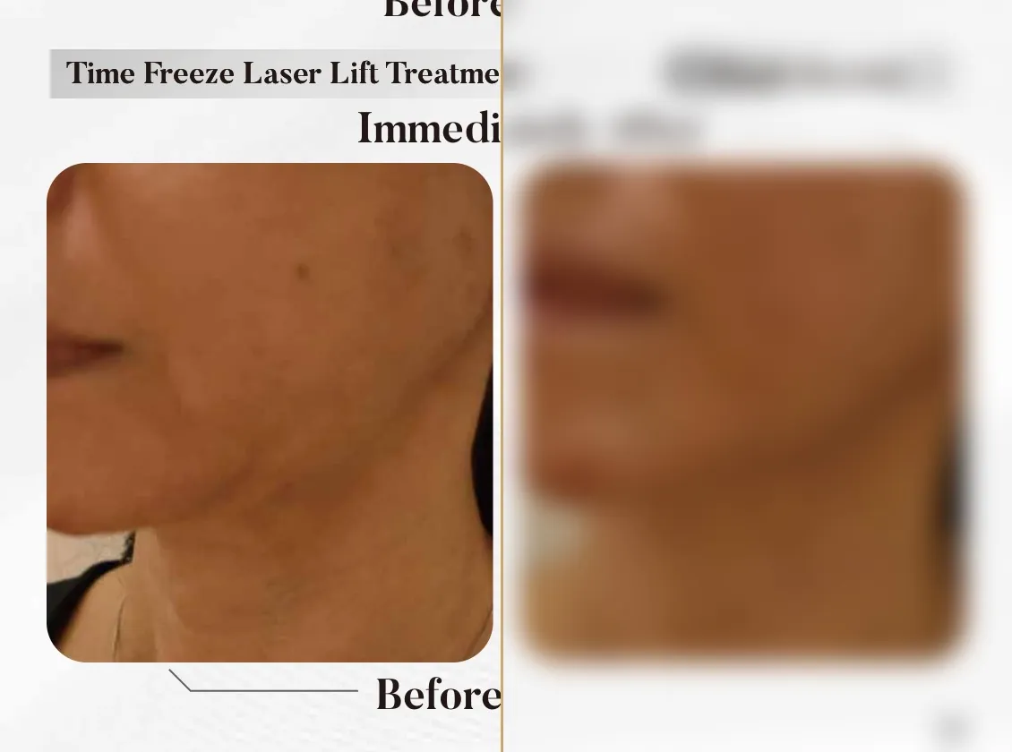 Time Freeze Laser Lift — Immediately After, Skin Close-Up (Single Session)