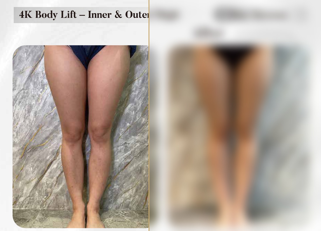4K Body Lift — Inner & Outer Thigh (Two Sessions)