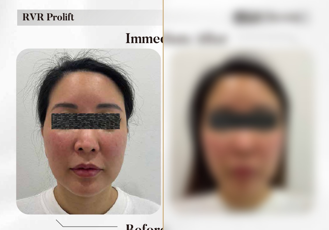RVR ProLift — Immediately After (Single Session)
