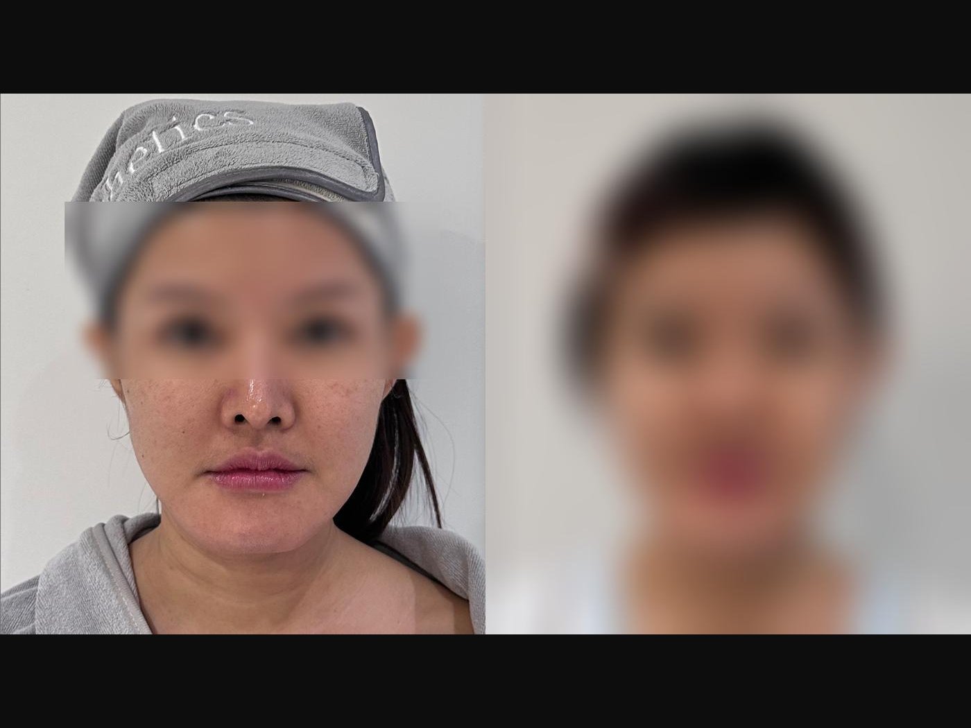 VF Facelift - Sharpens & Lifts Lower Face 7