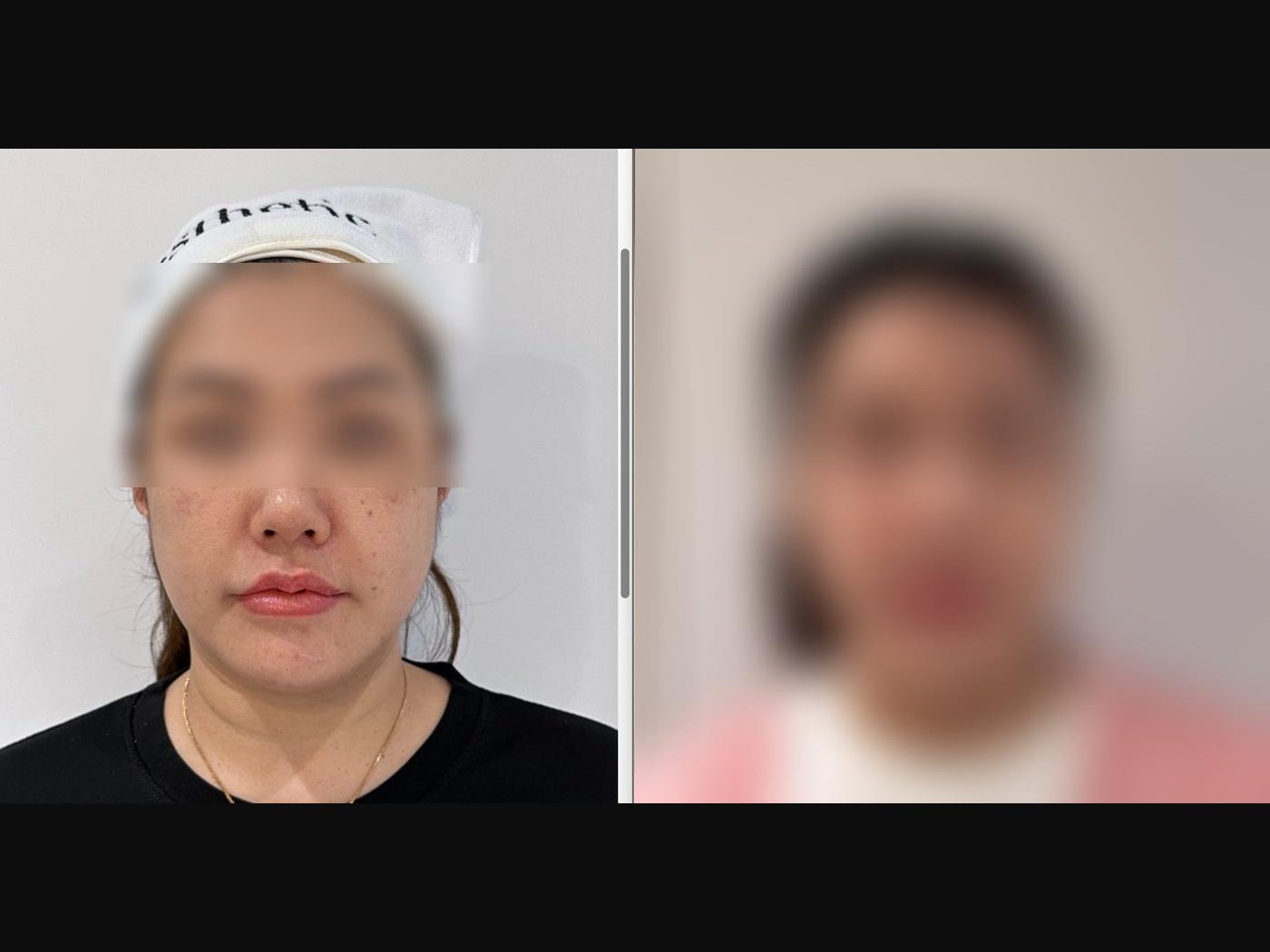 VF Facelift - Lifts Nasolabial Folds Jowls Double Chin 3