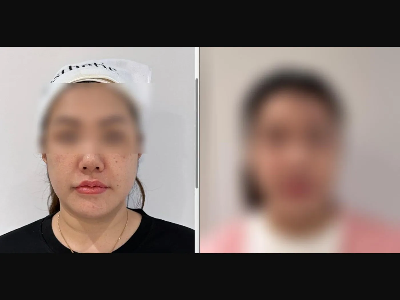 VF Facelift - Lifts Nasolabial Folds Jowls Double Chin 3