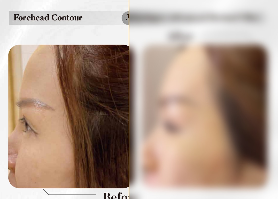 Dermal Filler — Forehead Contour (3 Syringes)