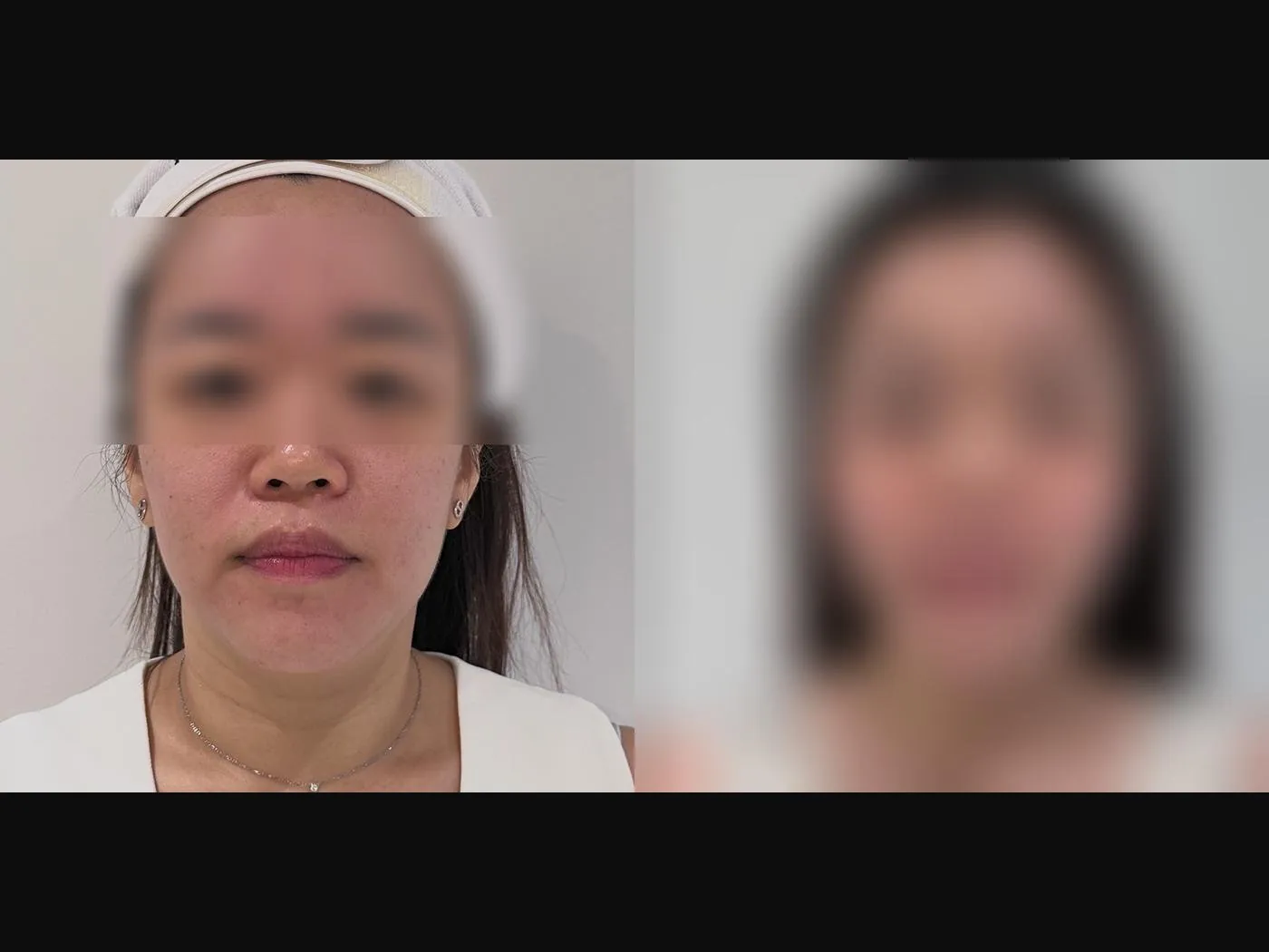 VF Facelift - Sharpens & Lifts Lower Face 6