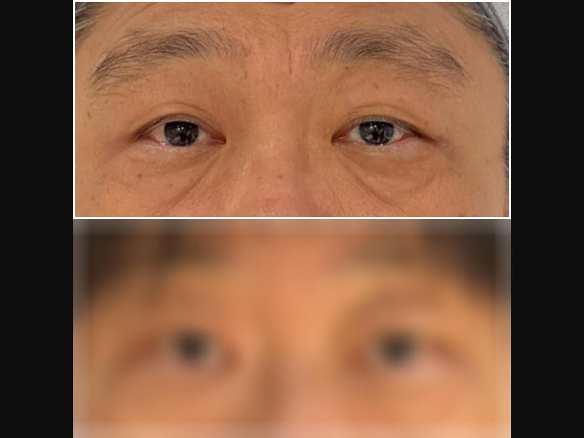 VF Periorbital Eyelift - Lifts Droopy Eyelids