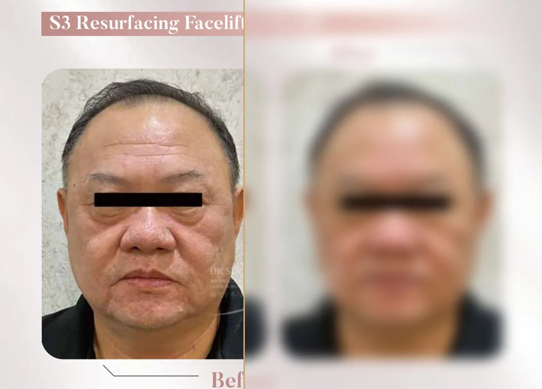 S3 Resurfacing Lift Laser — Facelift + Eyelift